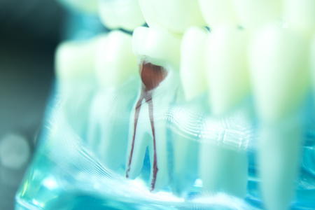 photo of a tooth root