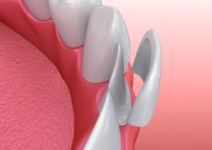 illustration of dental veneer